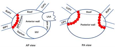 Low-Voltage Area at the Anterior Wall of the Left Atrium Is Associated With Thromboembolism in Atrial Fibrillation Patients With a Low CHA2DS2-VA Score